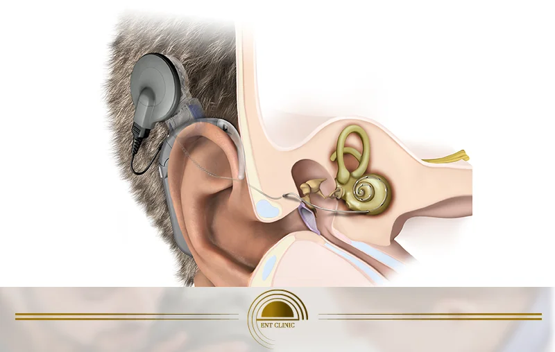 علاج العصب السمعي بالليزر %D8%B9%D9%84%D8%A7%D
